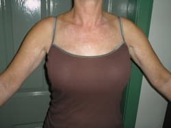 vitiligo-protocol